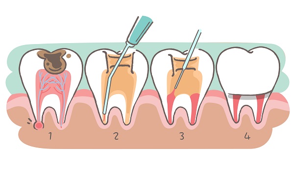 深圳杜牙根價錢