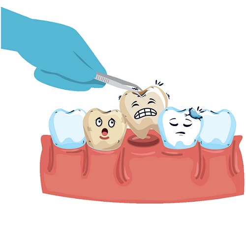 烂到牙根的牙齿必须拔吗